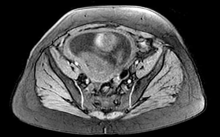 File:Colon adenocarcinoma with Krukenberg tumors, advanced pregnancy (Radiopaedia 67279-76645 A 22).jpg