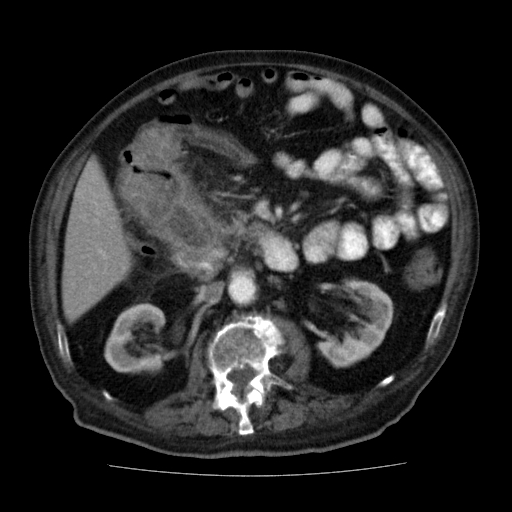 File:Colon cancer with duodenal invasion (Radiopaedia 16278-15958 A 26).jpg