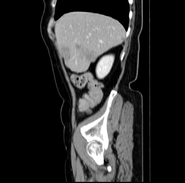 Colon carcinoma with hepatic metastases (Radiopaedia 29477-29961 C 11).jpg
