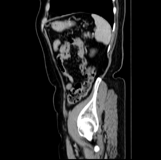 Colon carcinoma with hepatic metastases (Radiopaedia 29477-29961 C 46).jpg