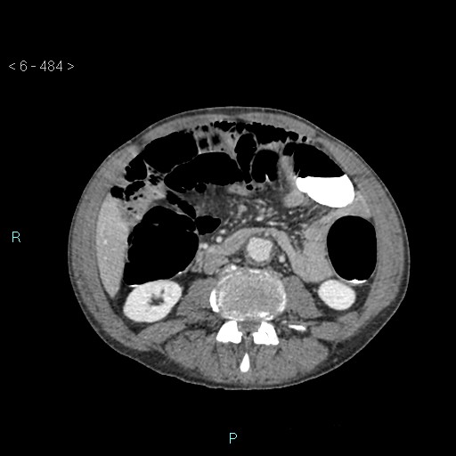 File:Colonic cancer (ultrasound and TC imaging) (Radiopaedia 50346-55713 A 58).jpg