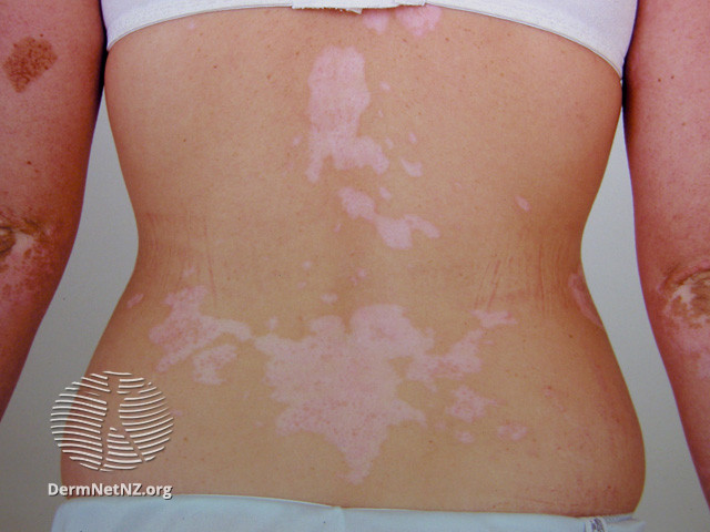 File:DermNet NZ colour-vitiligo-23.jpg