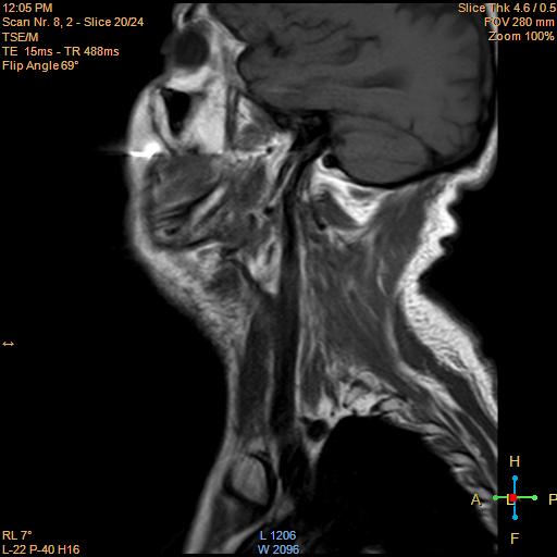 File:Nasopharyngeal carcinoma (Radiopaedia 22375-22403 Sagittal T1 15).jpg