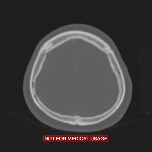 File:Nasopharyngeal carcinoma recurrence - skull base destruction (Radiopaedia 29107-29490 Axial bone window 21).jpg