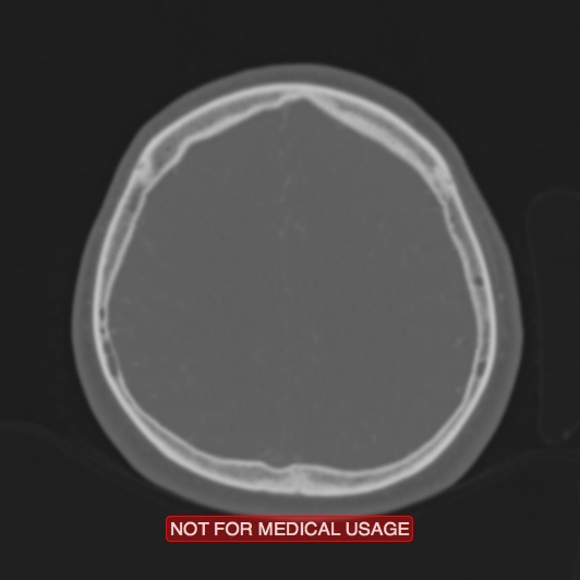 Nasopharyngeal carcinoma recurrence - skull base destruction (Radiopaedia 29107-29490 Axial bone window 29).jpg