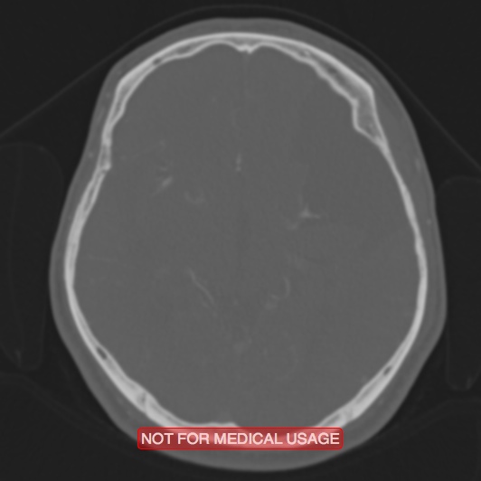 Nasopharyngeal carcinoma recurrence - skull base destruction (Radiopaedia 29107-29490 Axial bone window 57).jpg