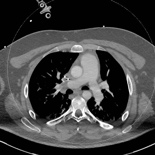 Neck CT angiogram (intraosseous vascular access) (Radiopaedia 55481-61945 B 29).jpg