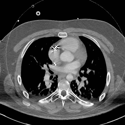 Neck CT angiogram (intraosseous vascular access) (Radiopaedia 55481-61945 B 7).jpg