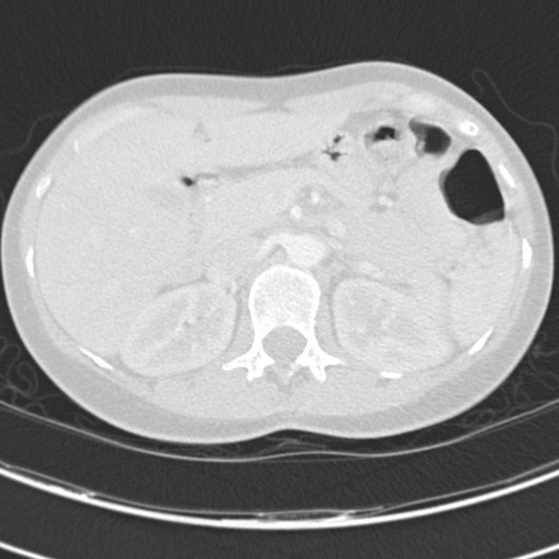 Necrobiotic pulmonary nodules - Crohn disease (Radiopaedia 20723-20631 Axial lung window 150).jpg