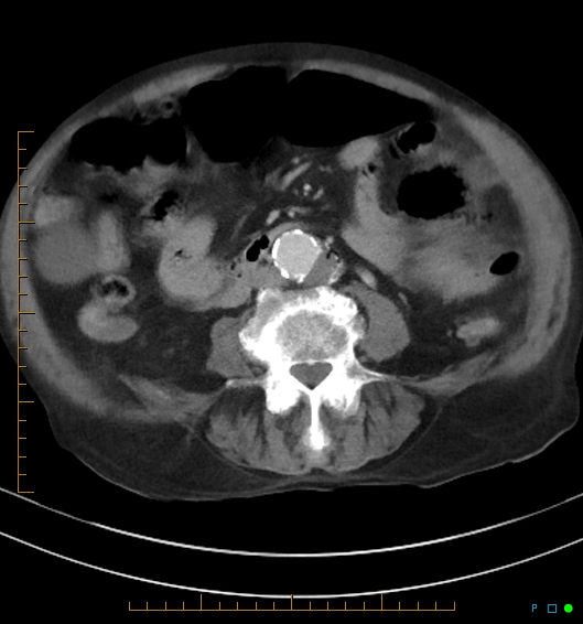 Necrotzing fasciitis due to a perforated adenocarcinoma of the splenic flexure (Radiopaedia 46930-51455 A 38).jpg