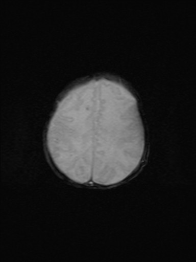 File:Neonatal hypoxic-ischemic encephalopathy (Radiopaedia 41406-44277 Axial Gradient Echo 6).jpg
