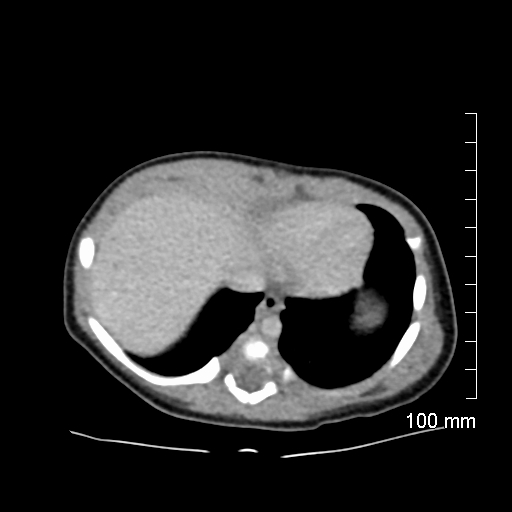 File:Neonatal neuroblastoma (Radiopaedia 56651-63438 Axial non-contrast 13).jpg