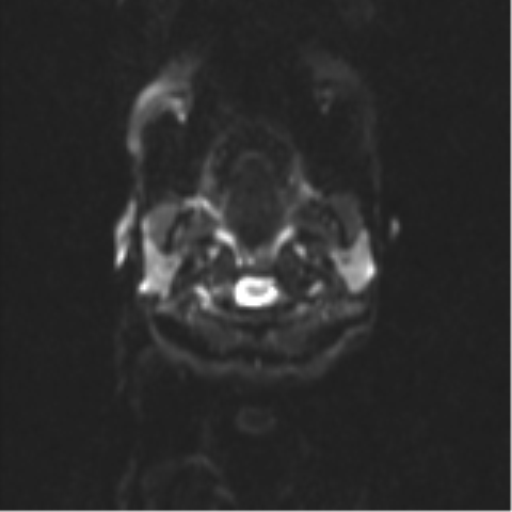 Neurenteric cyst (Radiopaedia 58641-65837 Axial DWI 1).png