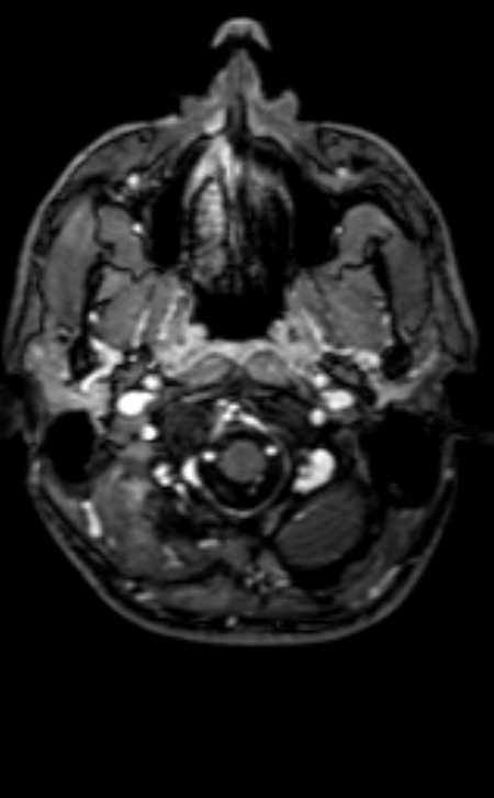 Neuro-Behçet disease (Radiopaedia 90112-107294 Axial T1 C+ 196).jpg