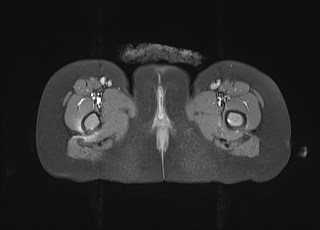 File:Neuroblastoma with bone metastases (Radiopaedia 67080-76414 Axial T1 C+ fat sat 39).jpg