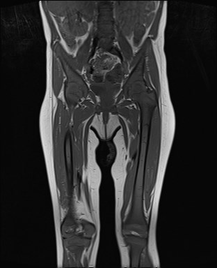 File:Neuroblastoma with bone metastases (Radiopaedia 67080-76414 Coronal T1 11).jpg