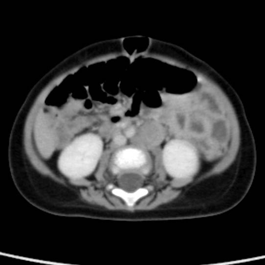 Neuroblastoma with skull metastases (Radiopaedia 30326-30960 C 35).jpg