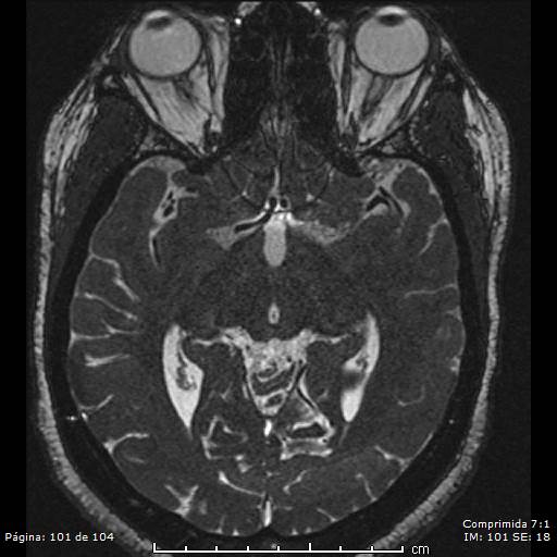 Neurocysticercosis (Radiopaedia 58636-65832 I 101).jpg