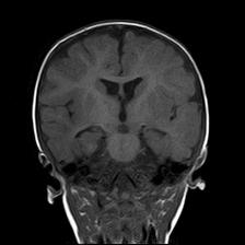 File:Neurofibromatosis type 1 (Radiopaedia 30089-30671 Coronal T1 15).jpg