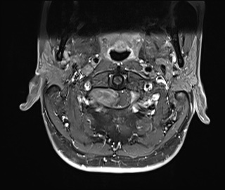 File:Neurofibromatosis type 1 (Radiopaedia 80355-93740 Axial T1 C+ fat sat 3).jpg