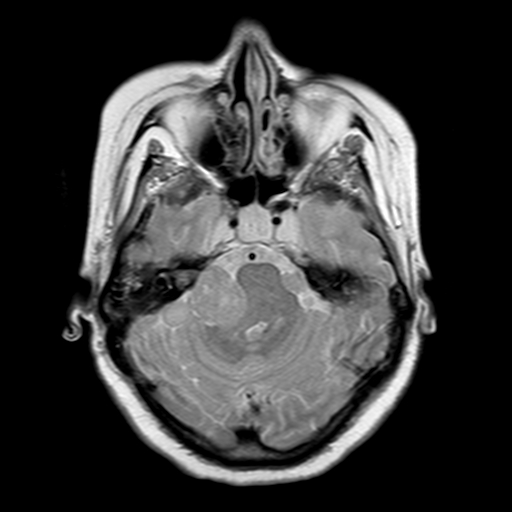 File:Neurofibromatosis type 2 (Radiopaedia 8713-9518 Axial Gradient Echo 18).jpg
