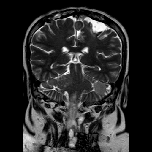File:Neurofibromatosis type 2 (Radiopaedia 8713-9518 Coronal T2 16).jpg