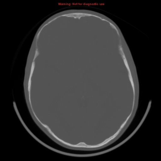 File:Neurofibromatosis type 2 (Radiopaedia 8953-9732 Axial bone window 18).jpg