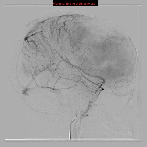 File:Neurofibromatosis type 2 (Radiopaedia 8953-9733 C 16).jpg