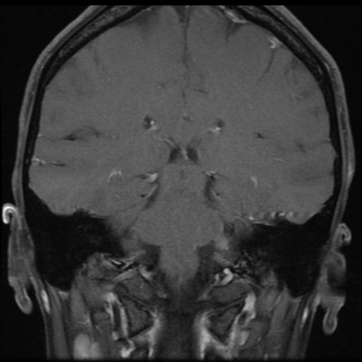File:Neurofibromatosis type 2 - bilateral acoustic neuromata (Radiopaedia 40060-42566 Coronal T1 C+ 4).png