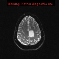 File:Neuroglial cyst (Radiopaedia 10713-11184 Axial DWI 5).jpg