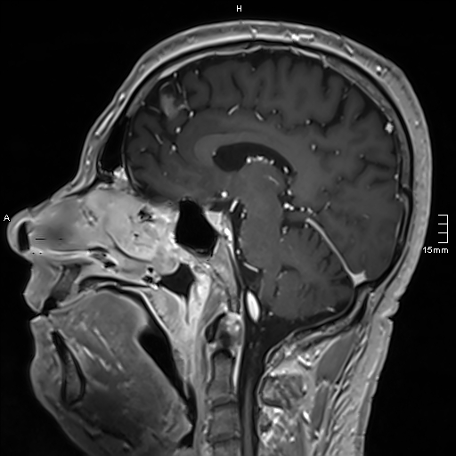 Neurosarcoidosis - involvement of the mesial temporal lobes (Radiopaedia 67429-76820 Sagittal T1 C+ 79).jpg
