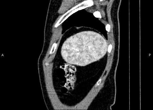 Non-syndromic pancreatic endocrine tumor (Radiopaedia 86958-103178 E 95).jpg