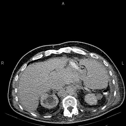 Non Hodgkin lymphoma in a patient with ankylosing spondylitis (Radiopaedia 84323-99621 Axial C+ delayed 17).jpg