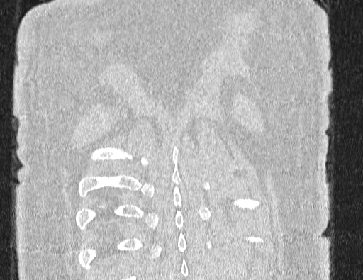 Non specific interstitial pneumonia (NSIP) (Radiopaedia 89725-106798 Coronal lung window 70).jpg