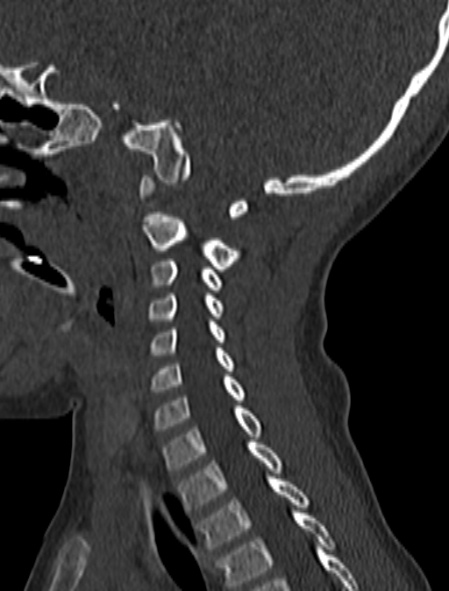Normal CT cervical spine - pediatric (Radiopaedia 52549-58462 Sagittal bone window 69).jpg
