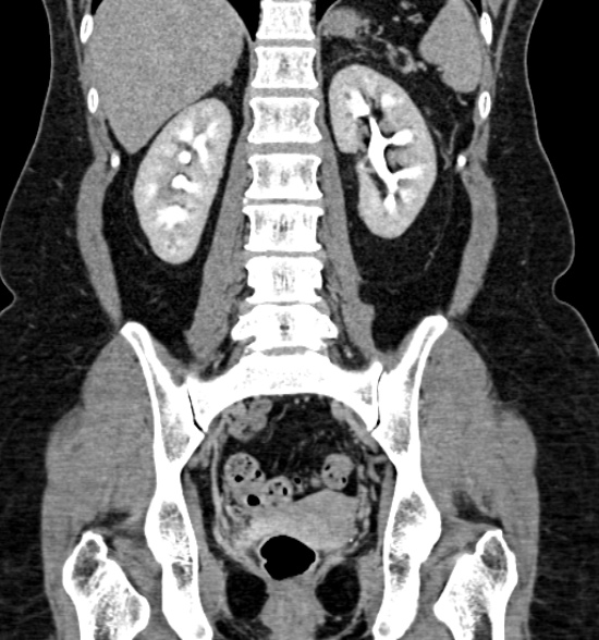 Normal CT intravenous urogram (Radiopaedia 39444-41759 A 310).jpg
