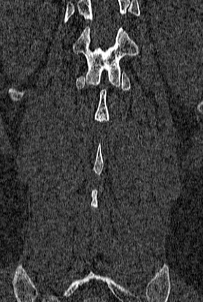 Normal CT lumbar spine (Radiopaedia 53981-60118 Coronal bone window 60).jpg