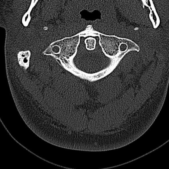 Normal CT of the cervical spine (Radiopaedia 53322-59305 Axial bone window 61).jpg