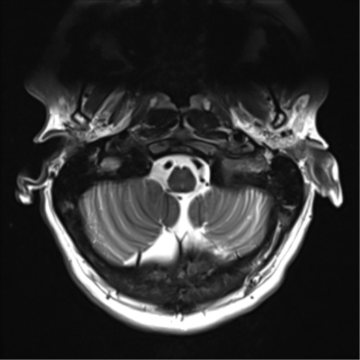 File:Normal MRI cervical spine (infection protocol) (Radiopaedia 53916-60039 Axial T2 5).png