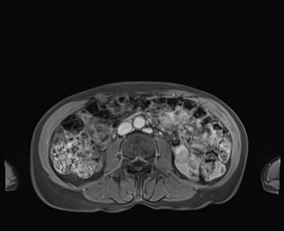 Normal adrenal glands MRI (Radiopaedia 82017-96004 M 56).jpg