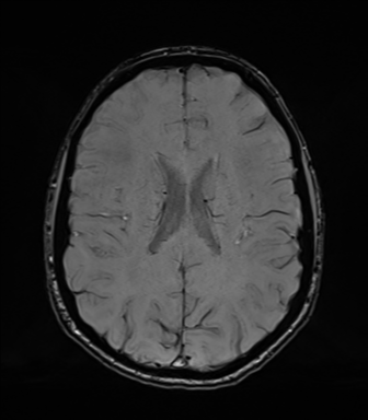 Normal brain MRI (TLE protocol) (Radiopaedia 40748-43405 Axial SWI 54).png