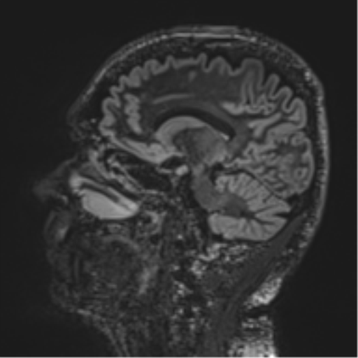 Normal brain MRI (non-focal epilepsy protocol) (Radiopaedia 53917-60040 Sagittal DIR 28).png