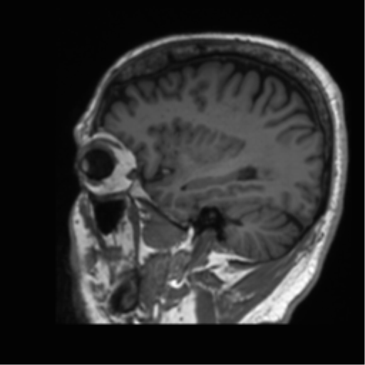 Normal brain MRI (non-focal epilepsy protocol) (Radiopaedia 53917-60040 Sagittal T1 16).png