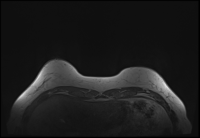 File:Normal breast MRI - dense breasts (Radiopaedia 80454-93850 Axial T1 24).jpg