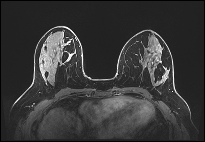 Normal breast MRI - dense breasts (Radiopaedia 80454-93850 C 101).jpg