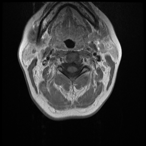 File:Normal cervical and thoracic spine MRI (Radiopaedia 35630-37156 Axial T1 C+ 26).png