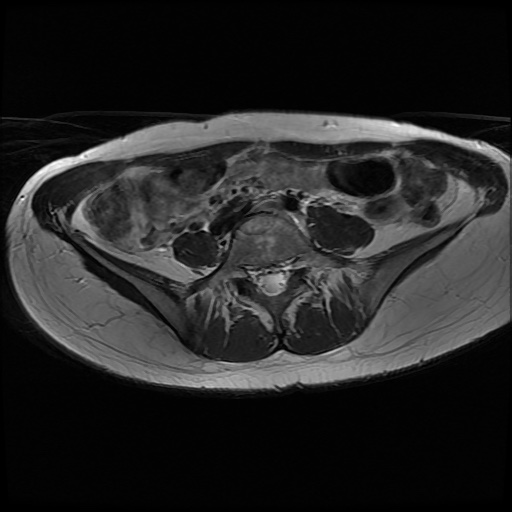 File:Normal female pelvis MRI (retroverted uterus) (Radiopaedia 61832-69933 Axial T2 3).jpg