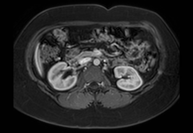 Normal liver MRI with Gadolinium (Radiopaedia 58913-66163 J 20).jpg