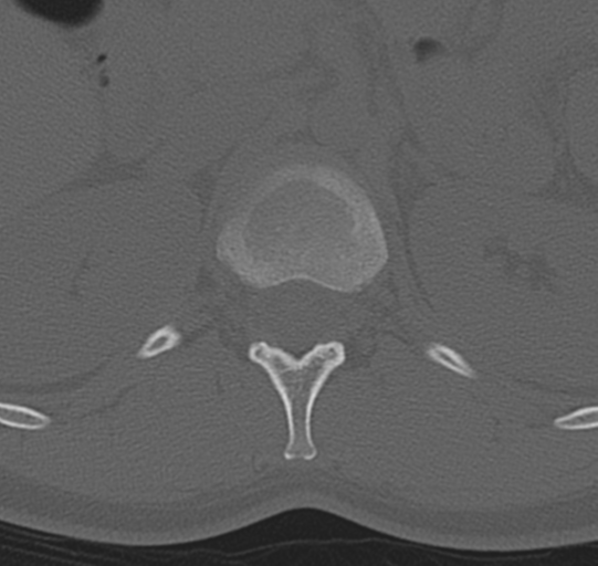 File:Normal lumbar spine CT (Radiopaedia 46533-50986 Axial bone window 4).png