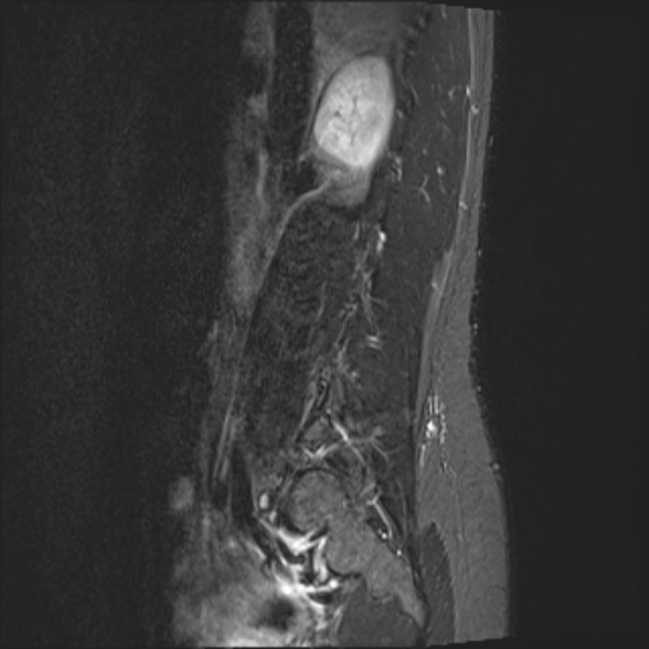 File:Normal lumbar spine MRI- 3 T (Radiopaedia 53280-59250 Sagittal STIR 4).jpg